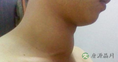 甲状腺肿瘤不开刀可以治好吗 甲状腺肿瘤不开刀可以治好吗