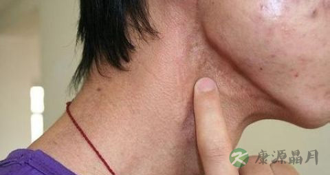 腮腺肿瘤的预防方法有哪些 腮腺肿瘤的预防方法有哪些