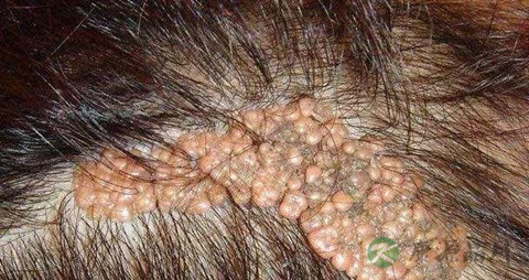 脑部良性肿瘤能治好吗 脑部良性肿瘤能治好吗