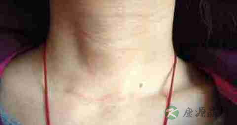甲状腺肿瘤会遗传吗 甲状腺肿瘤会遗传吗