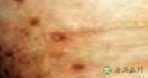 斑疹性梅毒疹的治疗 斑疹性梅毒疹的治疗