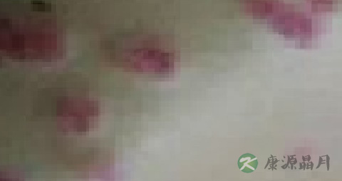 斑疹性梅毒疹的治疗 斑疹性梅毒疹的治疗