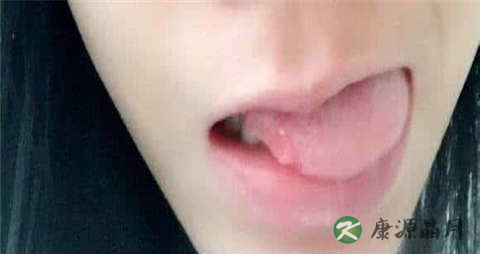 舌癌的症状 舌癌的症状