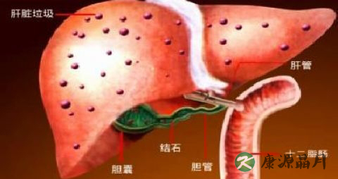 胆管结石怎么治疗 胆管结石怎么治疗