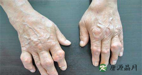 腱鞘炎的初期症状 腱鞘炎的初期症状