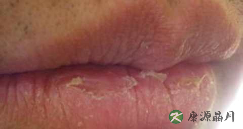 剥脱性唇炎怎么治 剥脱性唇炎怎么治