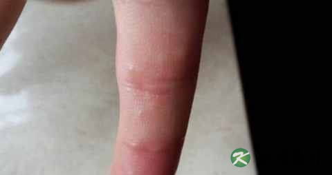 手指上长小水泡怎么治 手指上长小水泡怎么治