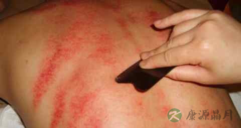 后背刮痧能去胃火吗 后背刮痧能去胃火吗