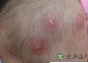 炎热夏季预防孩子长疖肿,这点你明白吗? 炎热夏季预防孩子长疖肿,这点你明白吗?