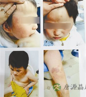 脑瘫儿在康复中心遍体鳞伤 对方称是孩子自残 脑瘫儿在康复中心遍体鳞伤 对方称是孩子自残