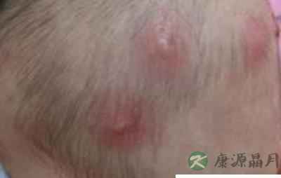 炎热夏季预防孩子长疖肿,这点你明白吗? 炎热夏季预防孩子长疖肿,这点你明白吗?