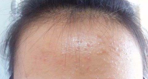 鼻子长痘痘的解决方法 鼻子长痘痘的解决方法