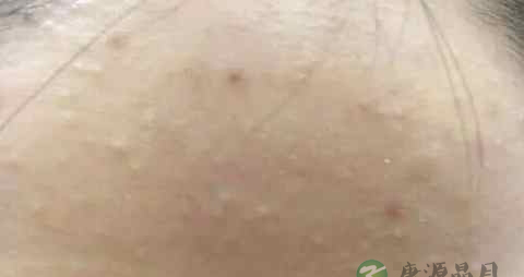 闭口粉刺会长成痘痘吗 闭口粉刺会长成痘痘吗