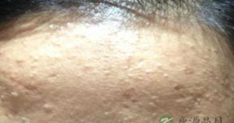 闭口粉刺如何快速消掉 闭口粉刺如何快速消掉