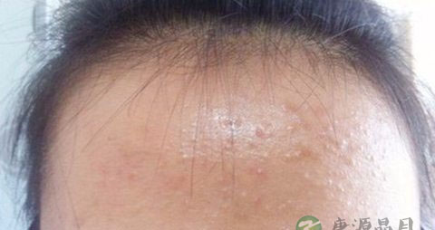 满脸闭口粉刺怎么去除 满脸闭口粉刺怎么去除