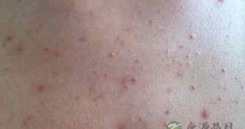 后背长粉刺是毛孔角化吗 后背长粉刺是毛孔角化吗