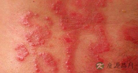 红斑狼疮原因 红斑狼疮原因