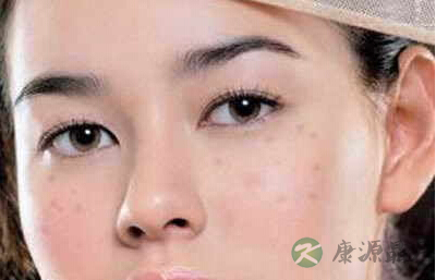 流行的治雀斑的偏方 流行的治雀斑的偏方