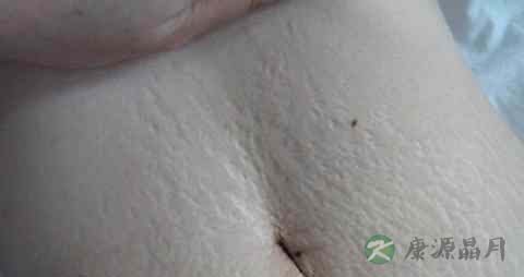 产后妊娠纹痒可以用皮炎平吗 产后妊娠纹痒可以用皮炎平吗