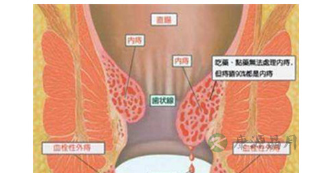 便血 便血