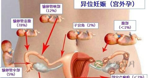 宫外孕 宫外孕