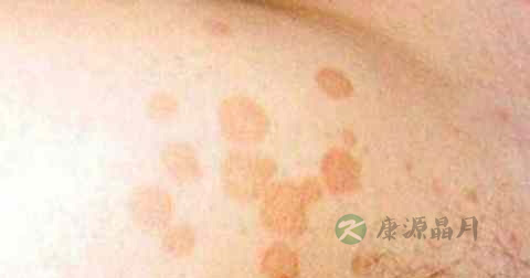 花斑癣 花斑癣