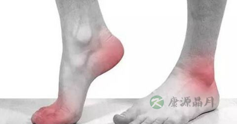 足底筋膜炎 足底筋膜炎