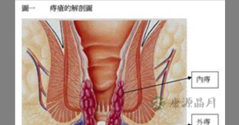 便血 便血