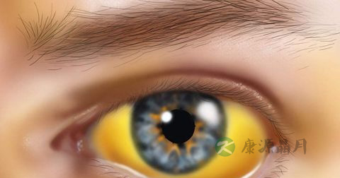 黄疸 黄疸