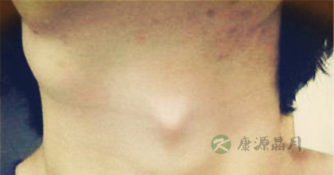 淋巴瘤 淋巴瘤