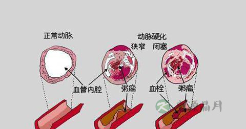 冠心病 冠心病