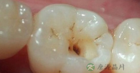 龋齿 龋齿
