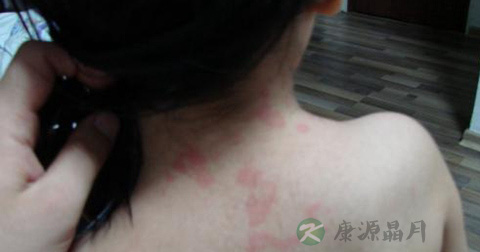 风疹 风疹