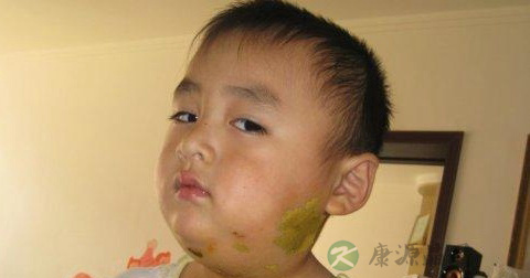 腮腺炎 腮腺炎