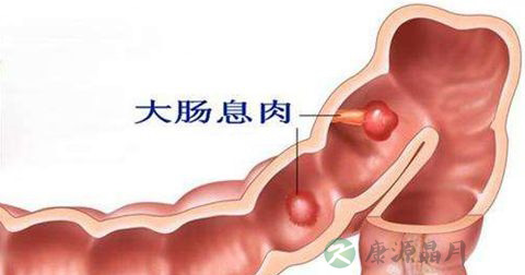 息肉 息肉