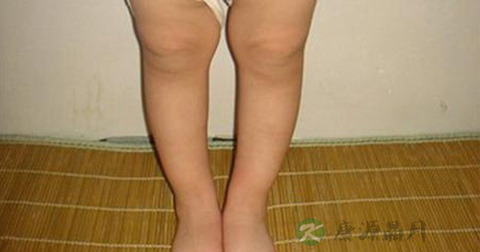 佝偻病 佝偻病