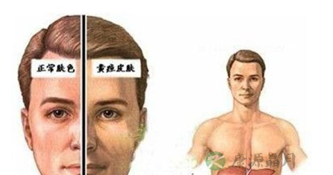 黄疸 黄疸
