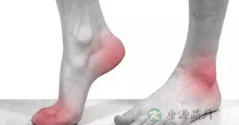 筋膜炎 筋膜炎