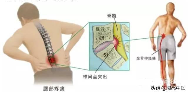 超级实用的腰腿痛临床诊断思维,值得收藏