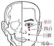 面瘫,可以选这些穴位治疗