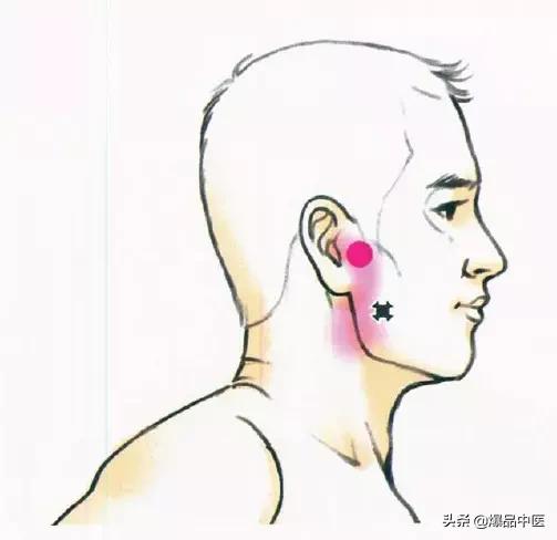 肌肉致头痛,肌肉治头痛