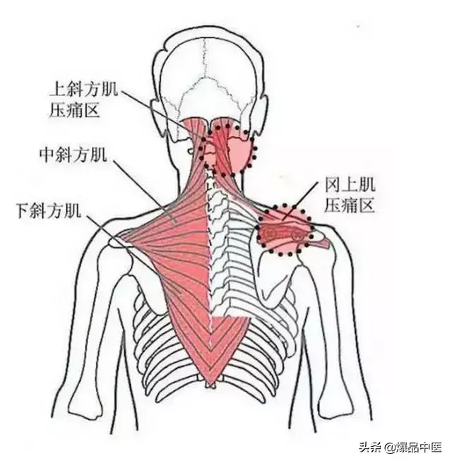 颈肩病常见的几个压痛点!治疗颈肩不适,经典好文章