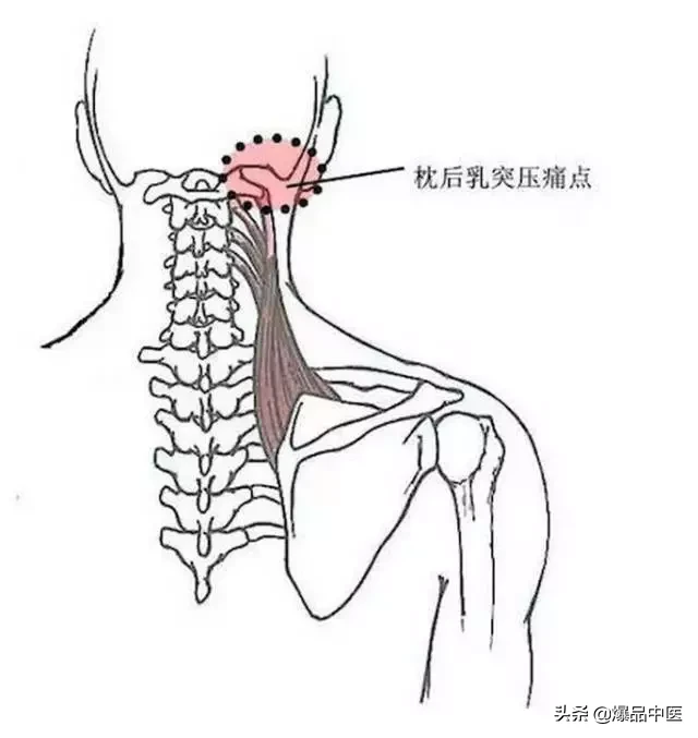 颈肩病常见的几个压痛点!治疗颈肩不适,经典好文章
