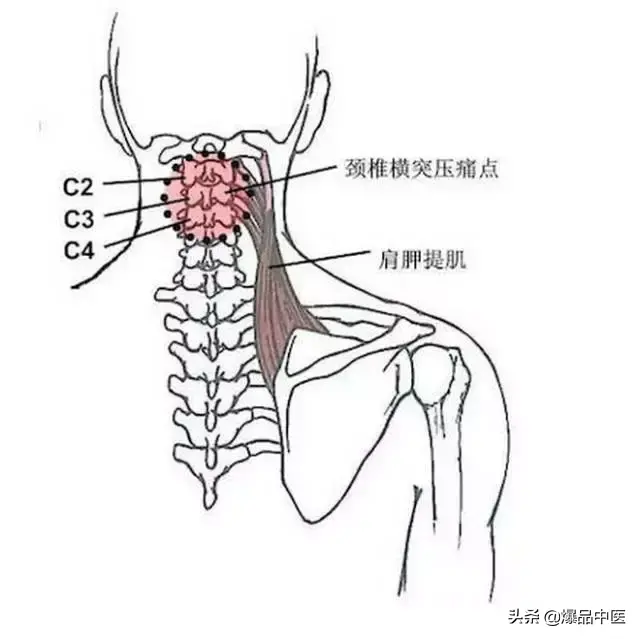 颈肩病常见的几个压痛点!治疗颈肩不适,经典好文章