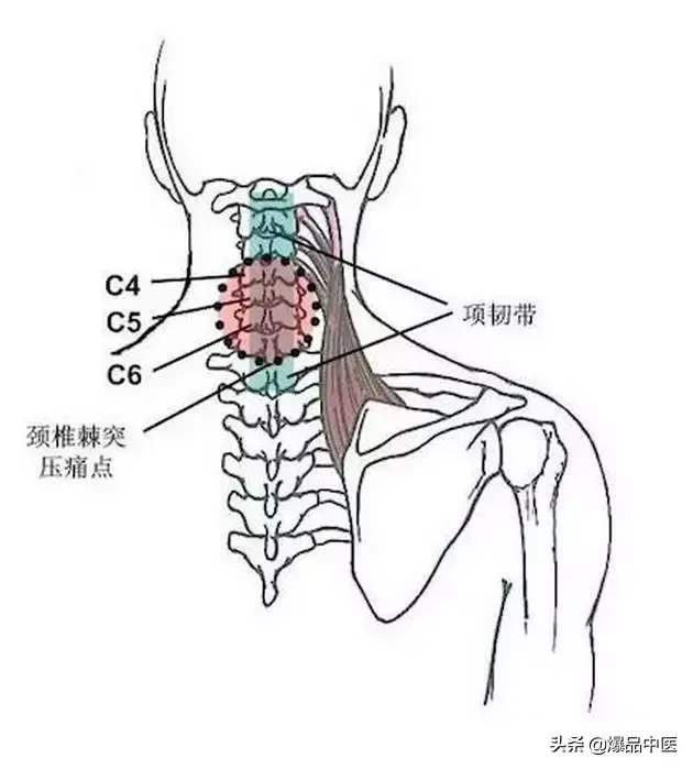 颈肩病常见的几个压痛点!治疗颈肩不适,经典好文章