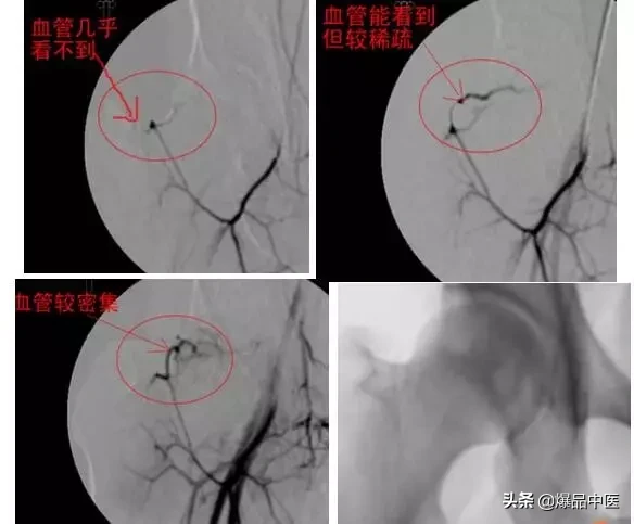 股骨头坏死的诊断与治疗策略,康源干货分享