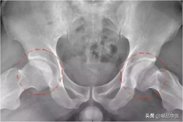 股骨头坏死的诊断与治疗策略,康源干货分享
