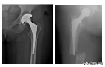 股骨头坏死的诊断与治疗策略,康源干货分享