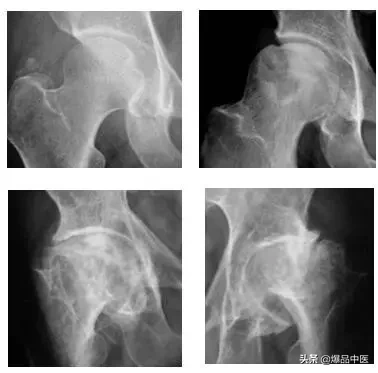 股骨头坏死的诊断与治疗策略,康源干货分享