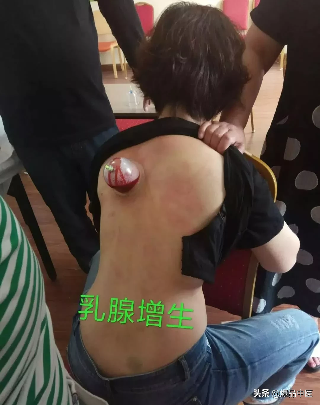 刺络放血,大病小病都不怕